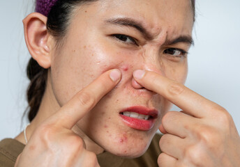 Asian woman pointing to acne inflamed on her face. Inflamed acne consists of swelling, redness, and...