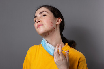 Maskne. A young Caucasian woman takes off her protective mask and shows pimples on her chin. Gray...