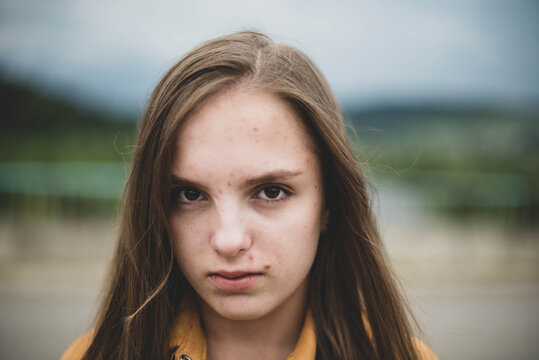 Portrait of young beautiful cute teenage girl woman with frackles and problematic skin on natural background. Girl power, body positive, real people.