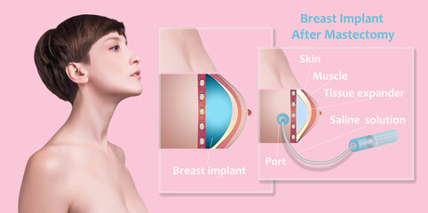 Plastic surgery of breast implants - obrazy, fototapety, plakaty
