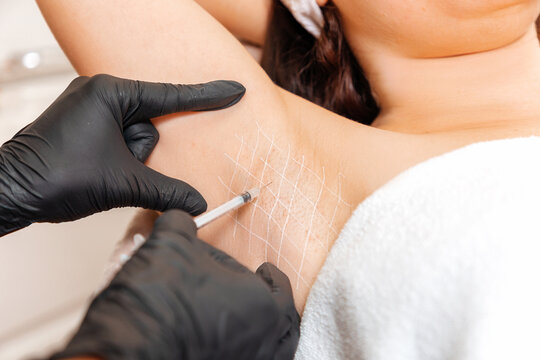 Cosmetologist in black latex gloves makes injection of botulinum toxin on the woman's axillary hollows against hyperhidrosis. Armpit with white drawn grid. Close up