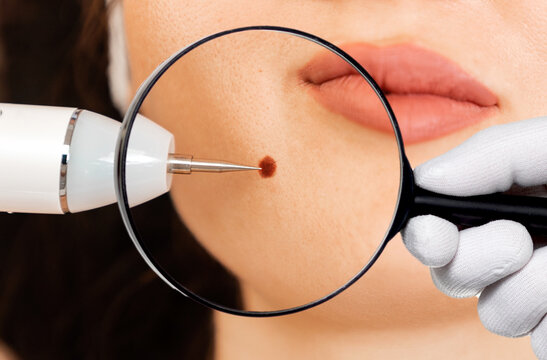 Microsurgery. Removal of birthmark from client's chin with laser device. Doctor's hand holding a magnifier glass for zoom. Close up. Concept of laser cosmelotogy and electrocoagulation