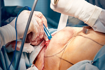 Mamoplasty, breast reconstruction, the surgeon's hands place an expander to correct the mammary...