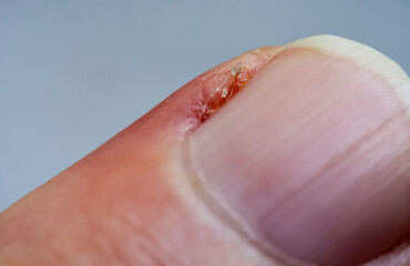 Inflamed cuticle on the finger. Damaged part of the finger, close-up.