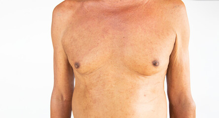Fototapeta na wymiar Skin rash on the front of the body from an allergic reaction in an elderly man.