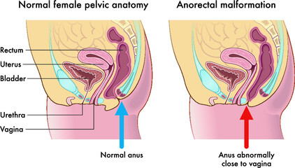 Medical illustration compares a normal female pelvic anatomy with one afflicted from anorectal malformation, with annotations