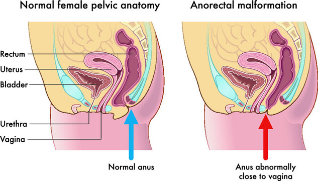 Medical illustration compares a normal female pelvic anatomy with one afflicted from anorectal malformation, with annotations
