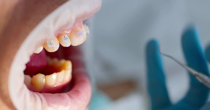 Close-up an open mouth with optragate and on the tooth of the upper jaw is correcting the position of a ceramic brace.