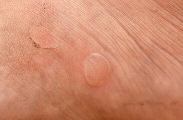 Fototapeta premium callus from shoes as a background