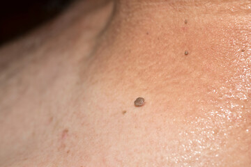 A snapshot of a papilloma located on a man's neck ..