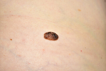 A snapshot of a large dark brown mole located on a woman's side.