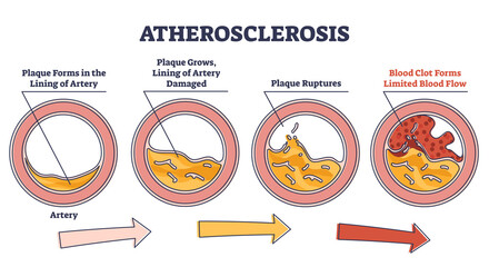 Atherosclerosis stages explanation and fatty plaque formation outline diagram. Artery side view with limited blood flow and rupture risk vector illustration. Dangerous health condition explanation.