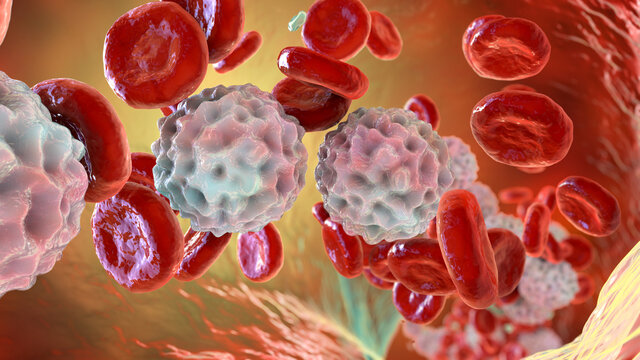 Lymphocytosis, illustration showing abundant white blood cells