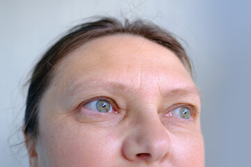 upper part of woman's face, an elderly woman close-up, small and large mimic wrinkles, eyes with spots, concept of poor vision, eye fatigue, drooping eyelid, correction of elasticity of aging skin