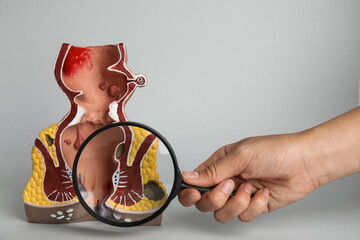 Proctologist holding magnifying glass near anatomical model of rectum with hemorrhoids on light...