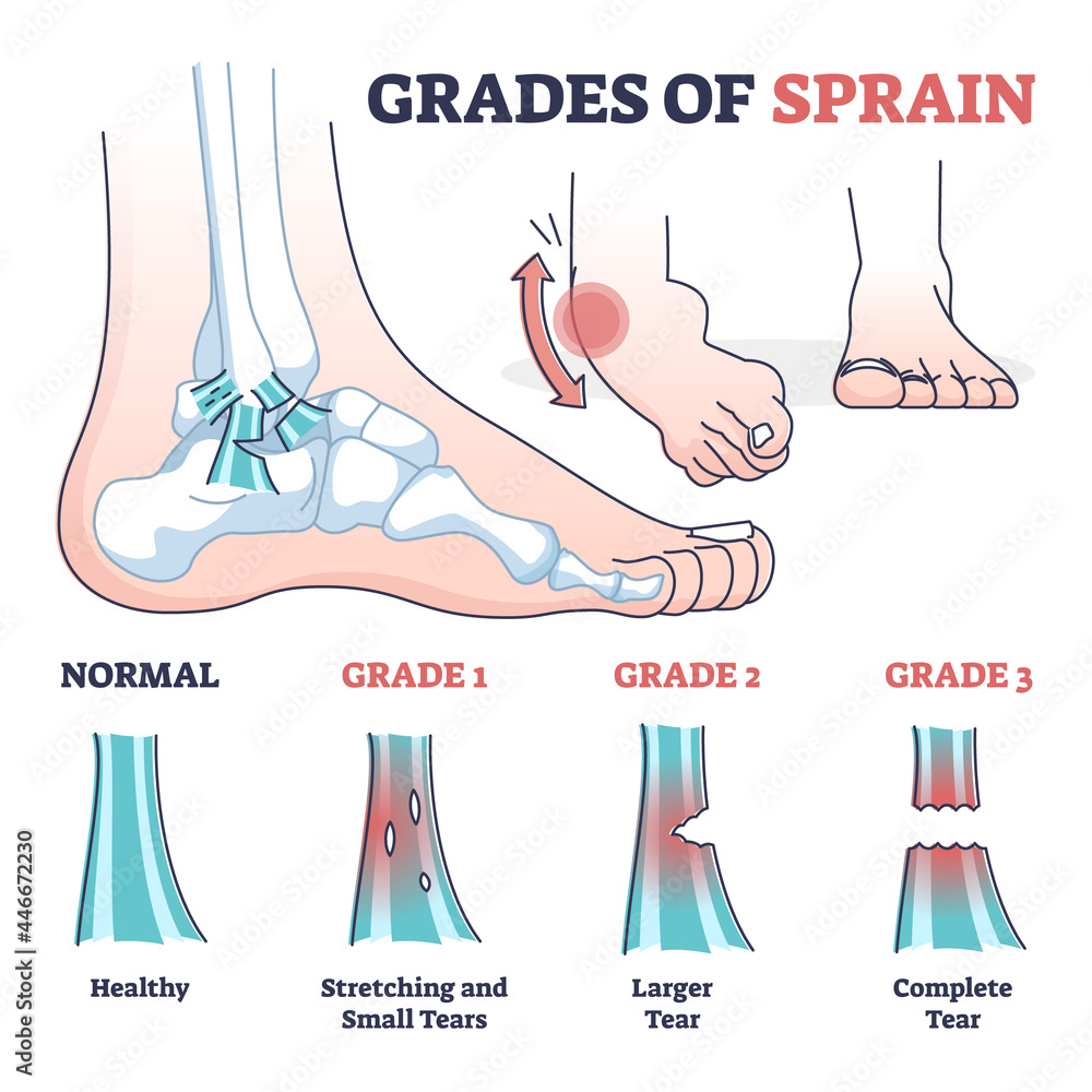 Wall mural Grades of sprain as ankle or foot medical injury levels outline diagram. Anatomical leg problem significance measurement and division vector illustration. Healthy, stretching and tears explanation.