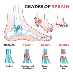 Grades of sprain as ankle or foot medical injury levels outline diagram. Anatomical leg problem significance measurement and division vector illustration. Healthy, stretching and tears explanation. - obrazy, fototapety, plakaty
