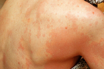 Severe allergic reaction on skin