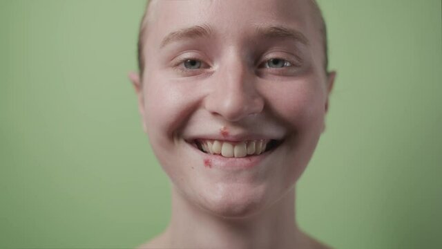 Young woman with herpes smiling for camera