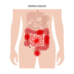 Chrons disease concept