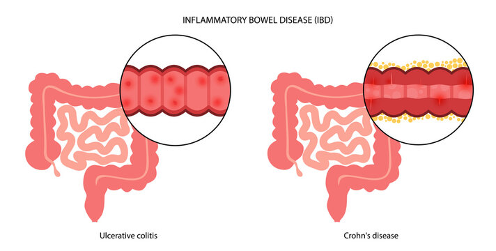 Inflammatory bowel disease
