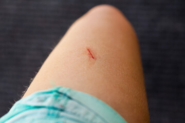 Fresh wound on the leg, thigh with blood. Skin texture. Body positive - body hair. Woman's leg. The...