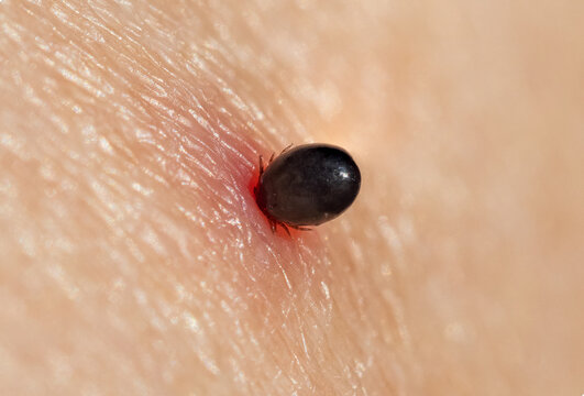 The castor bean tick in human skin