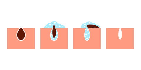 Deep cleansing of skin pores from blackheads, skin care. Procedure to wash dirt of skin of face. Removing sebum and cleaning with detergent. Vector illustration