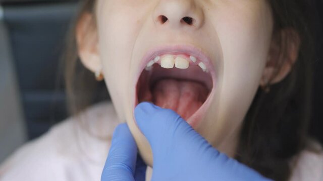 Examination of the open mouth of the child's girl at a doctor's appointment. A pediatrician in medical gloves examines the mouth of a 10-year-old girl.