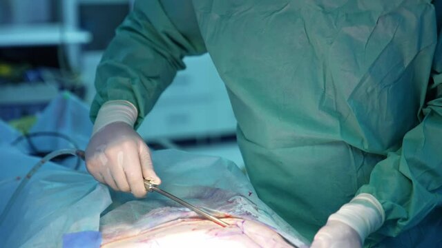 Surgeon gathering fat from patient's abdomen. Liposuction procedure by professional doctor. Filtration and pumping fat in the operating room.
