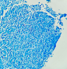 Photo of tissue with granulomatous inflammation, showing mycobacterium bacilli in AFB stain,...