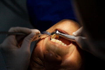 Close up dental examination and treatment, dental cleaning, dental instrument, hygienic dental