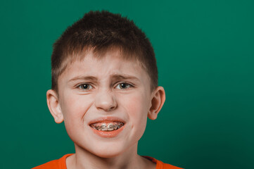 A boy of Caucasian nationality demonstrates a plate for straightening crooked and deformed teeth.
