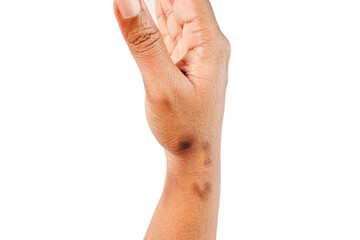 dry, dehydrated close up view of asian women hand with multiple deep black marks dermatitis problem...