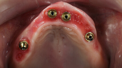 reconstructed gingiva after implantation of four implants in the upper jaw view in occlusion