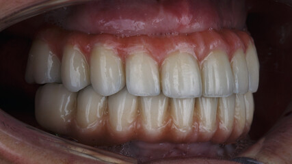 dentures in the occlusion in the oral cavity, side view