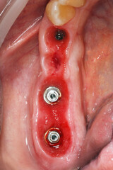 Fototapeta premium formed gingiva before prosthetics of a dental bridge for four teeth in the chewing area