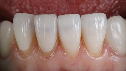 four ultra-thin dental veneers before bonding to the teeth