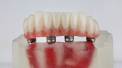 Dental prosthesis with pink gum on beam and special dental model on white background