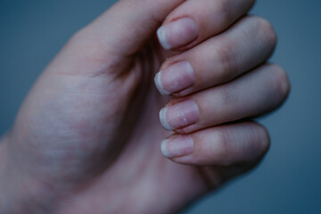 Close-up of brittle nails. Damage to the nail after using shellac or gel polish. Peeling on the...