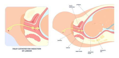 Labor swept drug baby Foley Strip sweep sac uterus hook Amnio fetus risk Cook ripe IV line bulb speed up plug mucus previa water vagina ripen first gland loop birth give method induce cervix sweeping