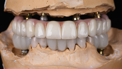Dental prosthesis from zircon and bridges on the model in the bite