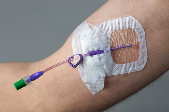 Picc (Peripherally Inserted Central Catheter) In The Arm Of A Man