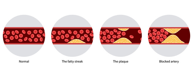 Cholesterol and atherosclerosis - 447164611