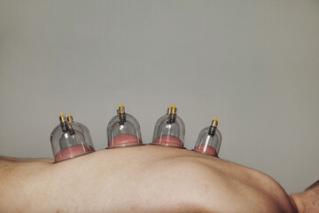 Close-up for multiple vacuum cups, medical cupping therapy