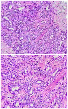 Photo of sclerosing adenosis of breast tissue, magnification 200x in the upper and 400x in the lower, photograph through a microscope