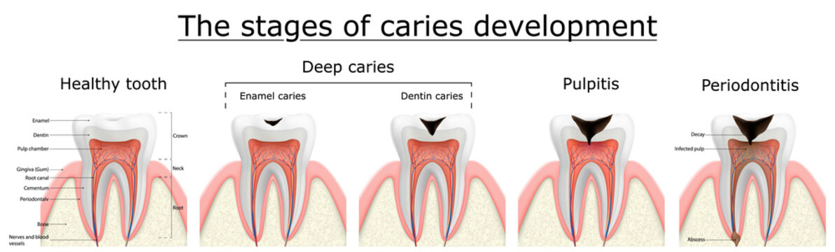 Stages of caries development. Dental disease: caries, pulpitis and periodontitis, realistic vector illustration