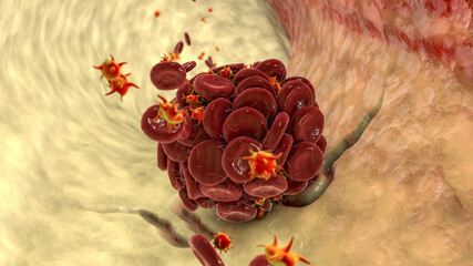 Blood clot in damaged blood vessel made of red blood cells, platelets and fibrin protein strands