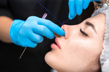 Cosmetic procedure for non-surgical rhinoplasty. The beautician inserts cosmetic threads into the...