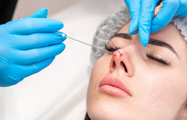 Cosmetic procedure for non-surgical rhinoplasty. The beautician inserts cosmetic threads into the...